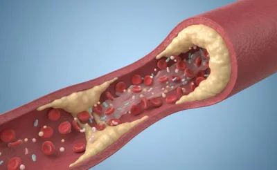 acumulación de placa en las arterias