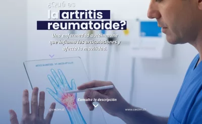 síntomas de artritis reumatoide